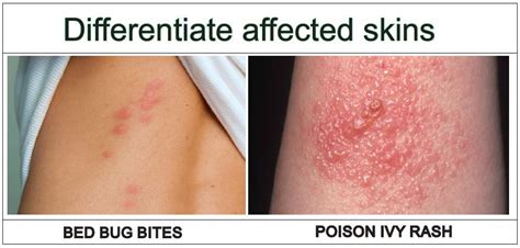 ant bites vs poison ivy